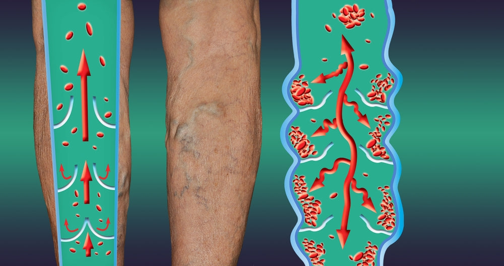 COVID-19 can increase the risk of blood clots