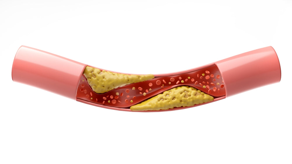 High blood pressure and blood clots: Causes and factors related to LPCVS